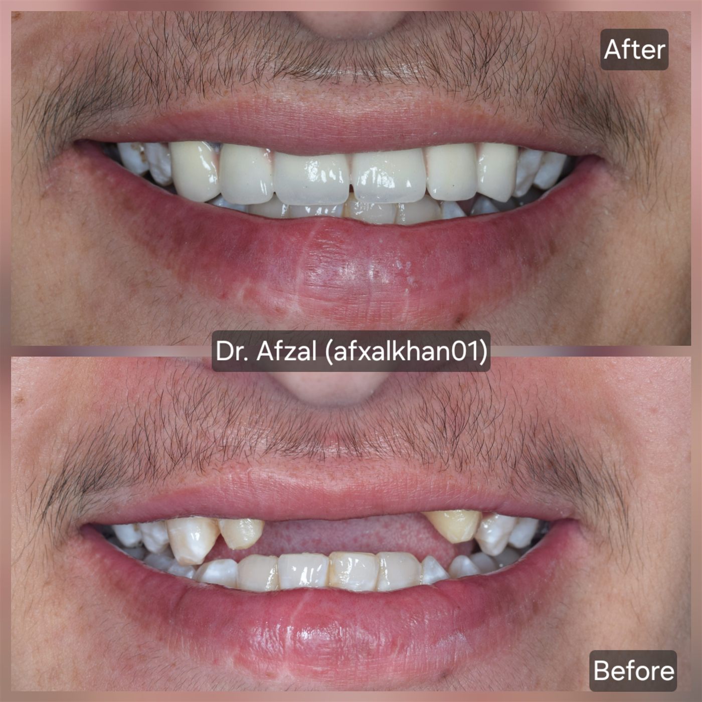 Smile Makeover — Case 1 — before and after