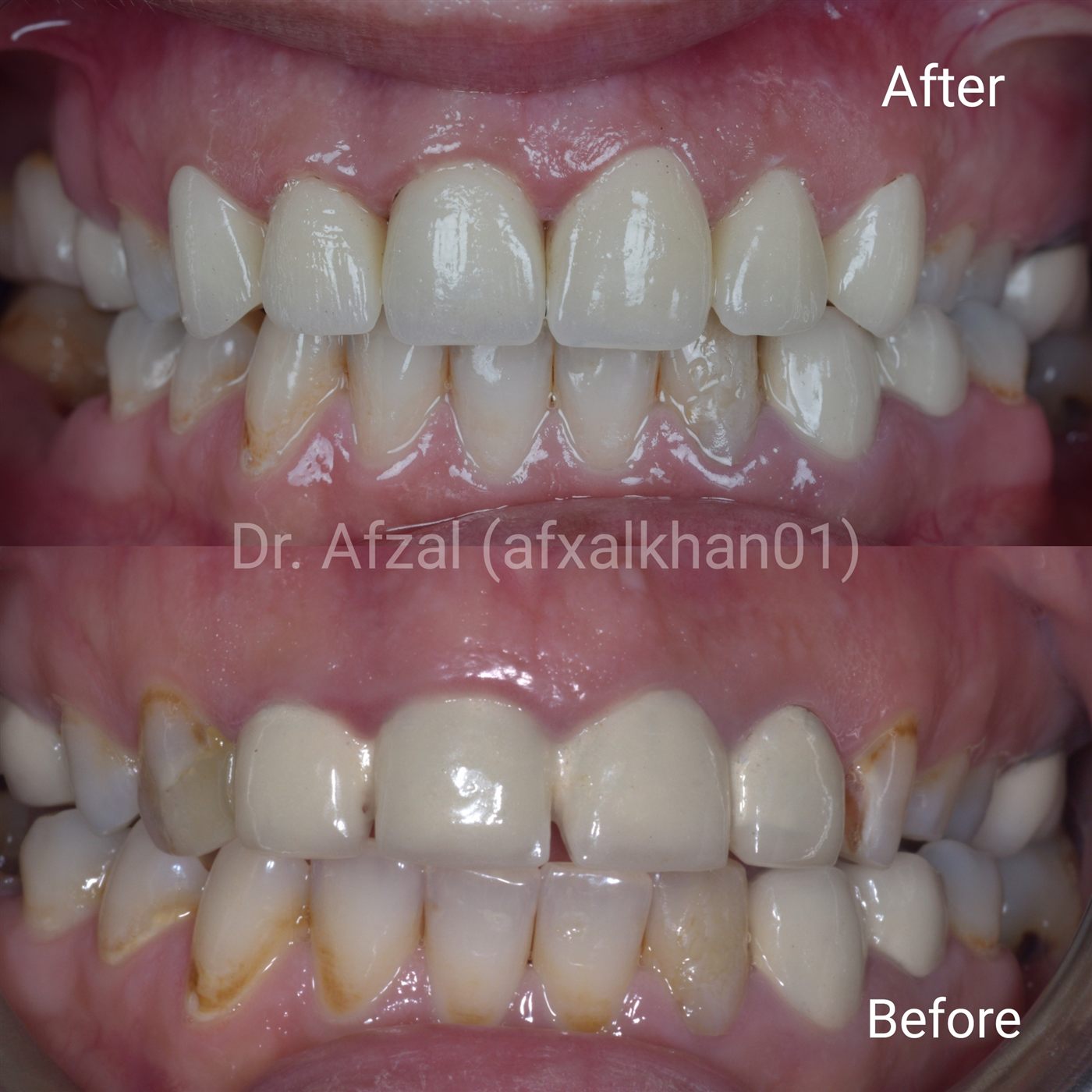 Smile Makeover — Case 2 — before and after