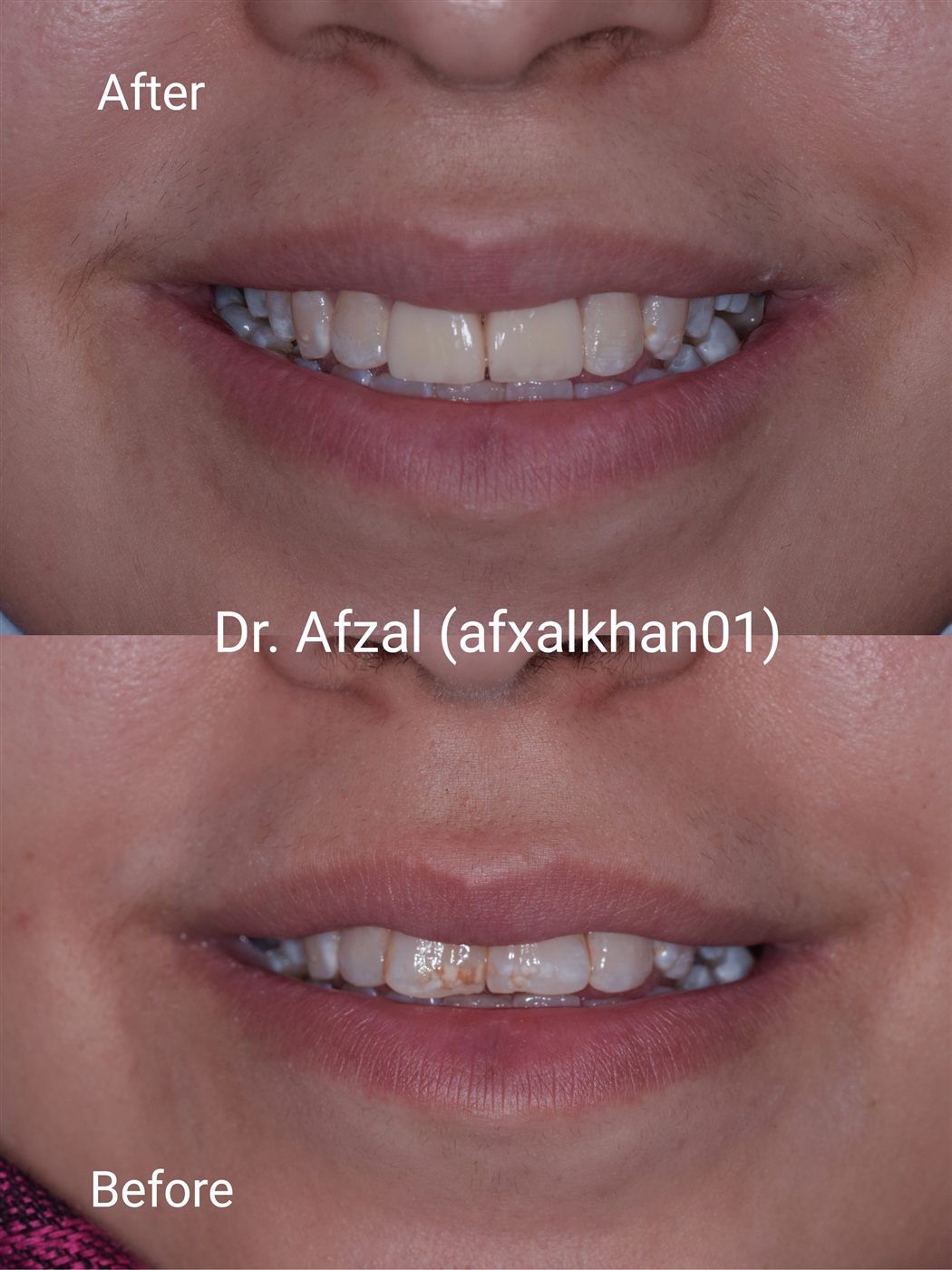 Smile Makeover — Case 3 — before and after