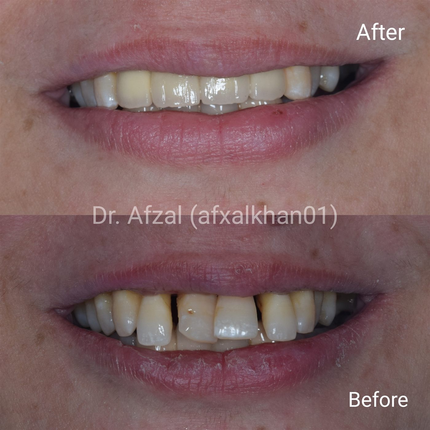 Smile Makeover — Case 4 — before and after