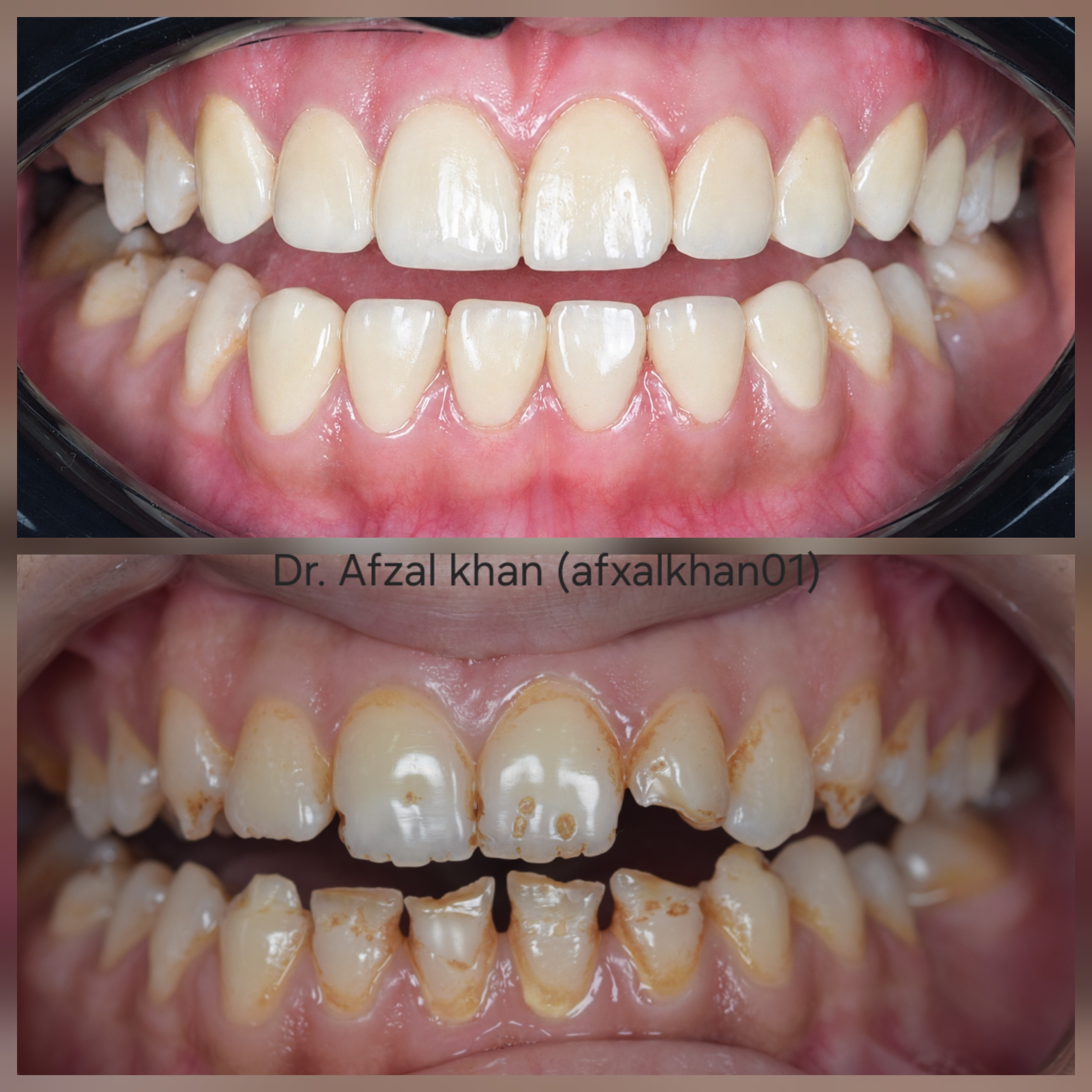 Smile Makeover — Case 5 — before and after