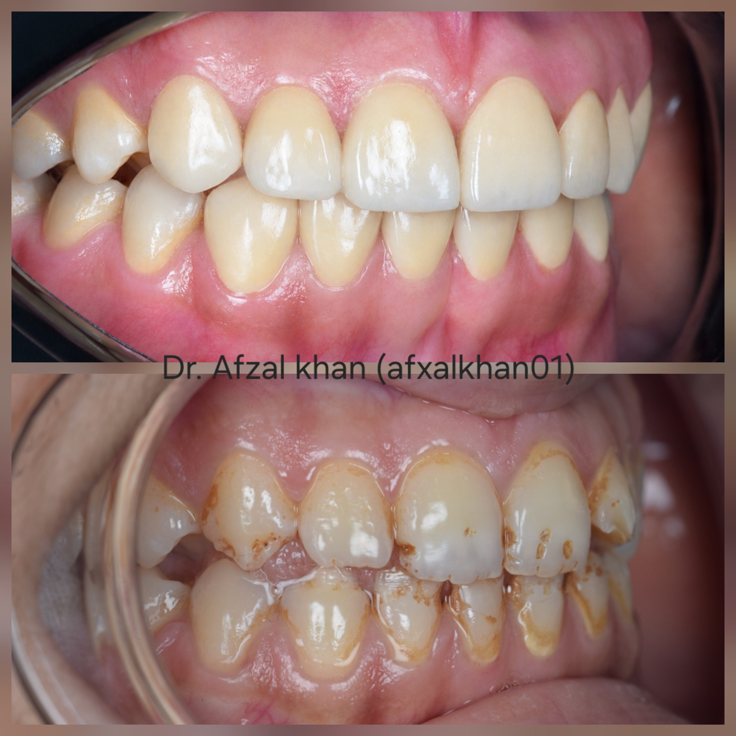 Smile Makeover — Case 6 — before and after
