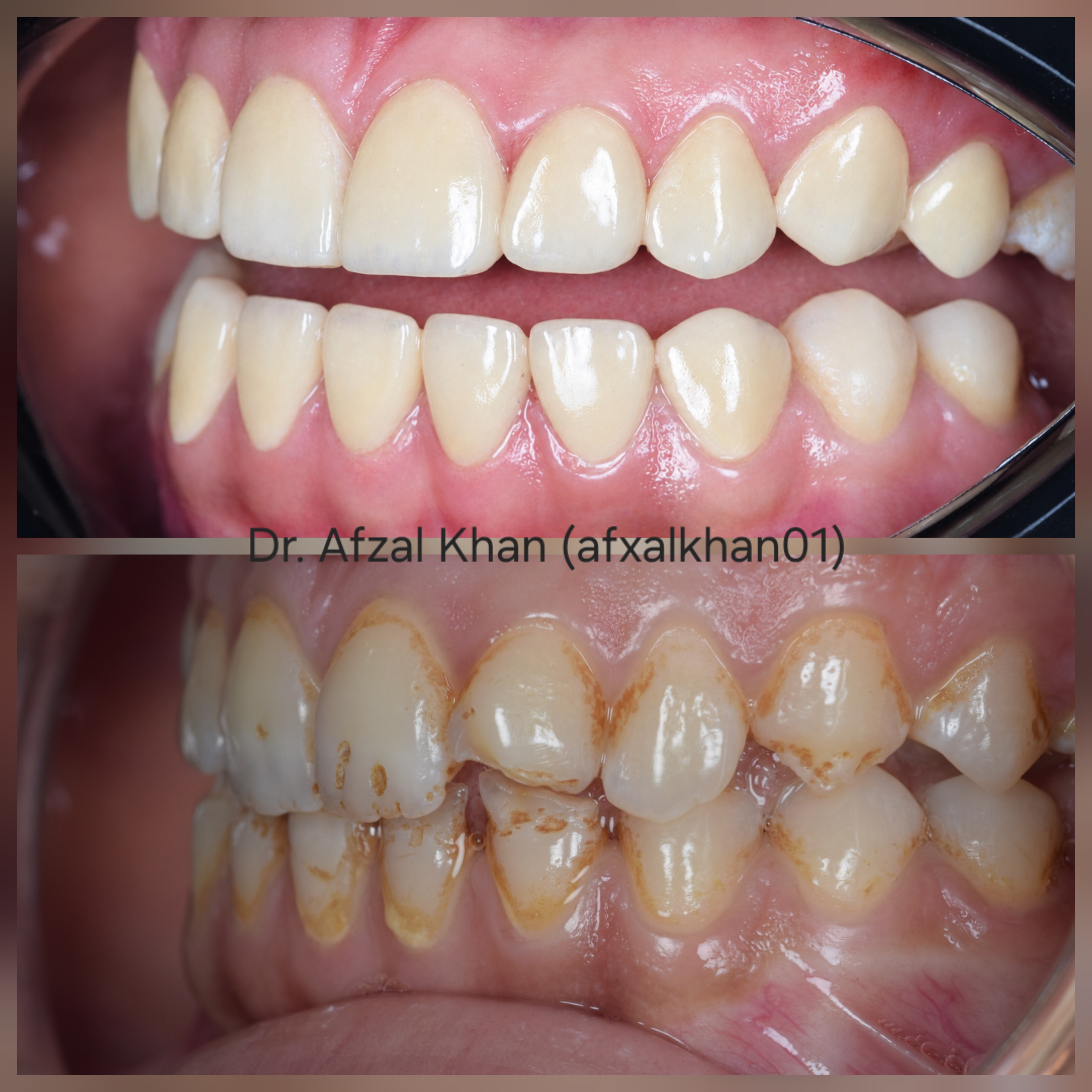 Smile Makeover — Case 7 — before and after