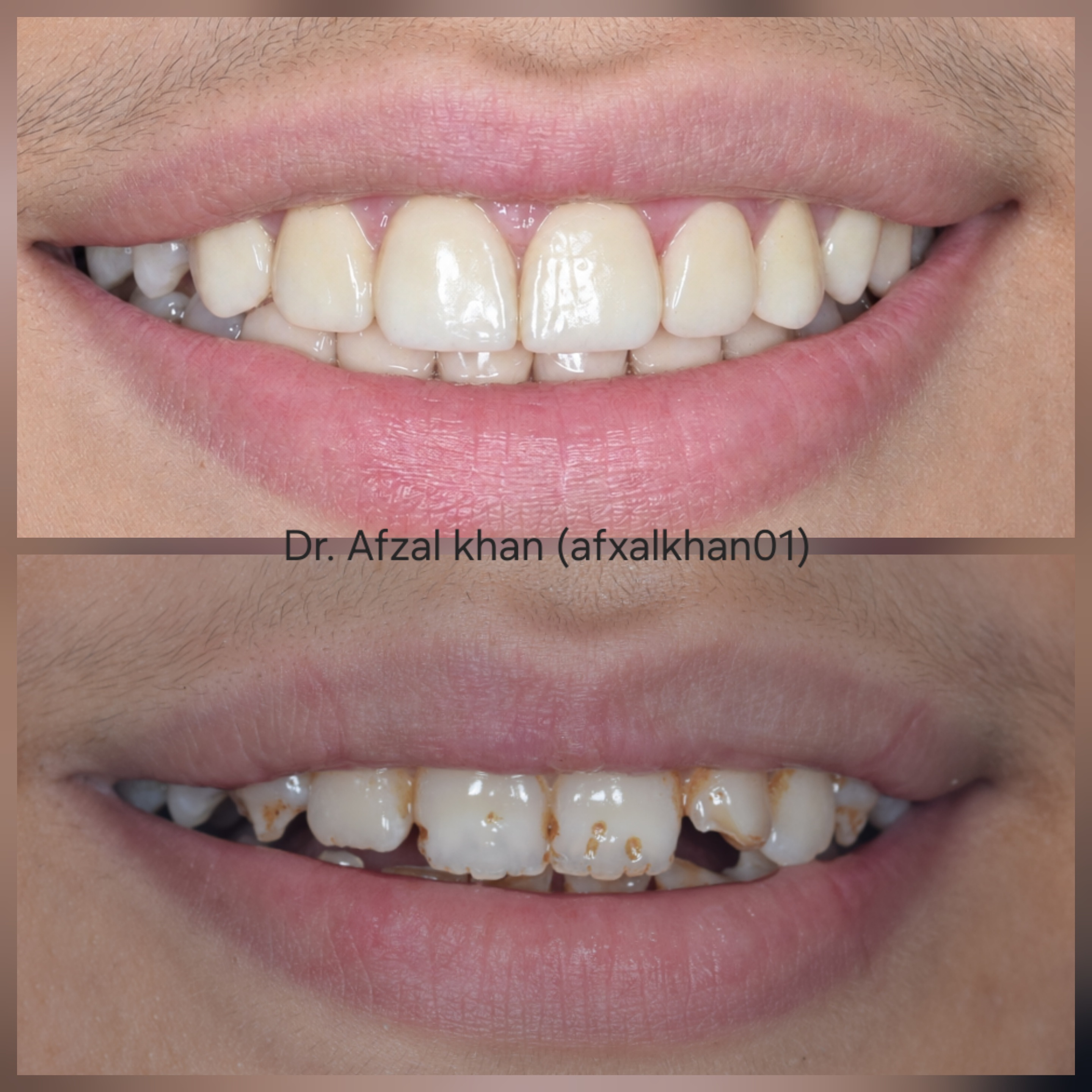 Smile Makeover — Case 8 — before and after